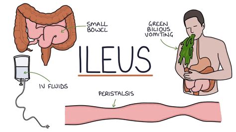 Understanding Ileus (Paralytic Ileus) - YouTube