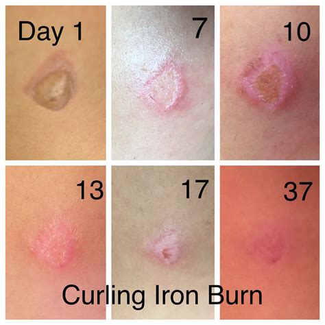 My healing process after getting a second degree burn from a curling ...