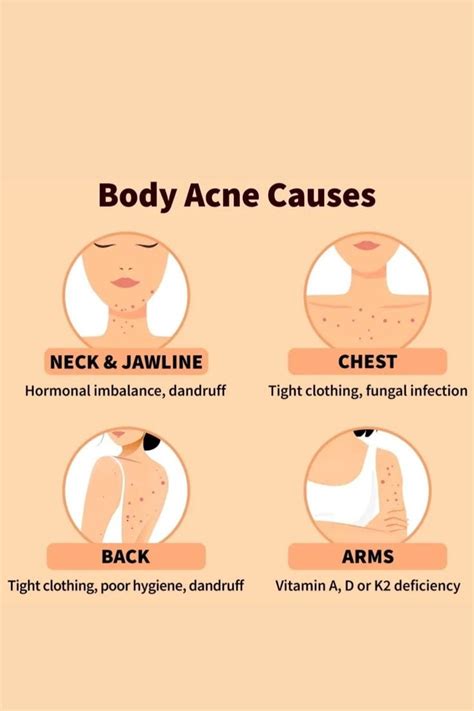 Body Acne Causes | Productos para el acné, Tipos de acné, Estetica de ...