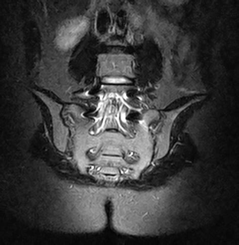 Sacroiliac joints MRI scan | Medserena Open MRI