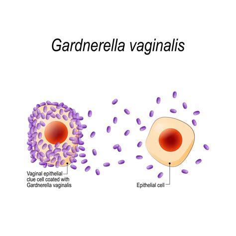 Gardnerella vaginalis infection: Causes and Treatments - – Archyde