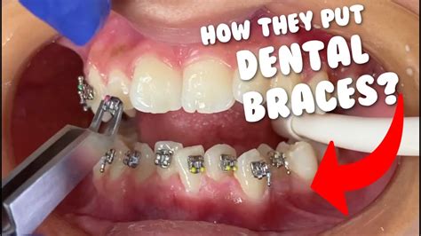 How they put braces - Dental Braces Tooth Time Family Dentistry New ...