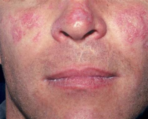 Lupus - Systemic Lupus Erythematosus (SLE) - Causes, Sign & Symptoms