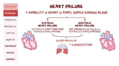 Heart failure: Pathology review: Video & Anatomy | Osmosis