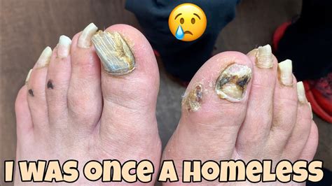 **EXTREMELY LONG TOENAILS TRIMMING** (HE WAS HOMELESS NOT SO LONG AGO ...