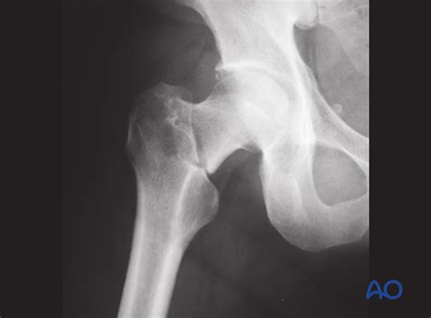 Complications and technical failures in femoral neck fracture management