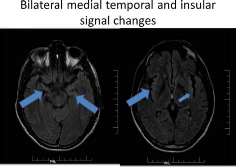 Medial temporal lobe signal changes in MRI. | Download Scientific Diagram