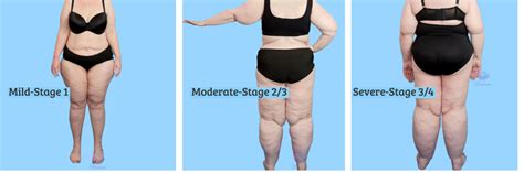 What Is Lipedema Diagnosis - Infoupdate.org