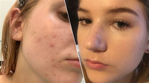 Accutane Side Effects: 9 Things to Know About the Acne Treatment | Glamour