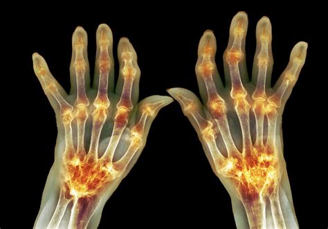 Rheumatoid Arthritis Flares Forewarned by Blood Levels of Newly ...