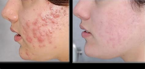 Tretinoin Cream 101: Effects, Benefits, and Best Usage