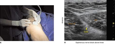 Saphenous Nerve Block Ultrasound