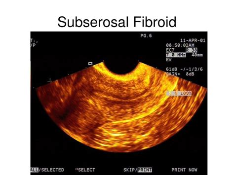 PPT - The Pelvic Scan: Early pregnancy problems Gynaecological ...