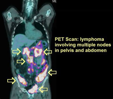 Lymphoma Images