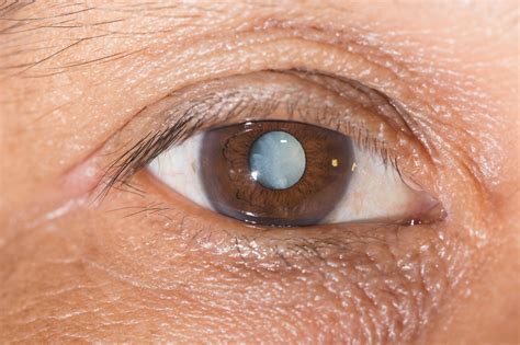 Cost of Cataract Surgery - Treatment Options, Recovery, Results