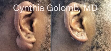 Treating keloids on ear lobes | Cynthia Golomb, MD | Dermatology Boutique