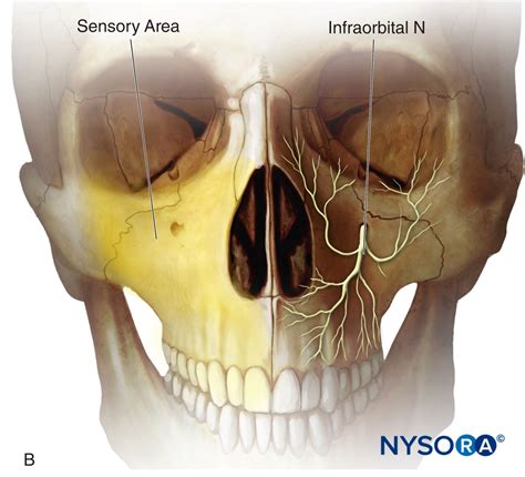 Infraorbital Nerve