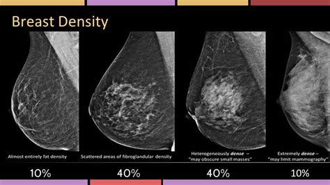 Dense Breast Clinic | Cooper University Health Care