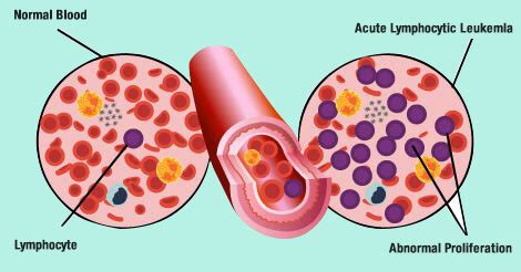 Blood Cancer Types