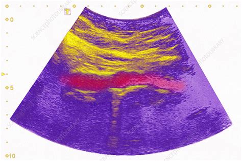 Calcific aortic atheroma, ultrasound - Stock Image - C030/6261 ...