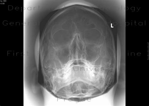 Radiology case: Le Fort II, fracture of facial skeleton