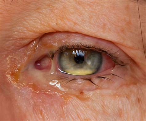 Eye Infections: All About Eye Infections