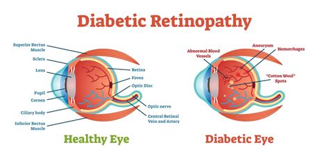 Diabetic Retinopathy Stages