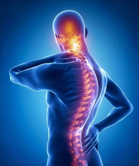 Scheuermann's Disease: Treatment in Fairfax, VA | SAPNA: Spine and Pain ...