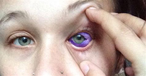 Sclera Tattoo Causes Model's Severe Eye Infection, Possible Blindness ...