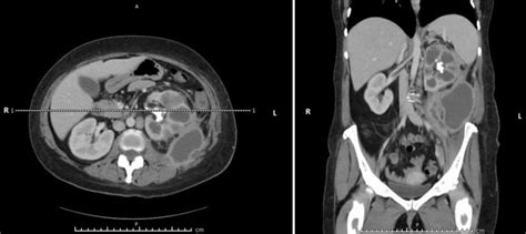 Representative image depicting a perinephric abscess measuring ...