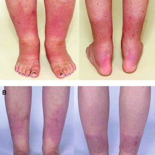 Pretibial Myxedema Pathophysiology