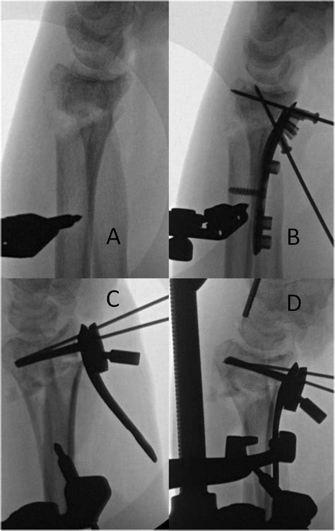 Restoring volar tilt using a volar plate as a reduction template (A and ...