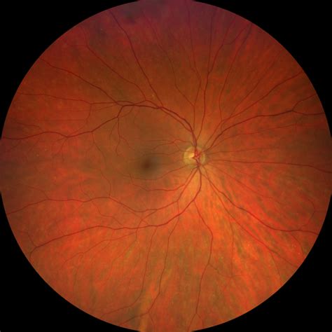 Diabetes: Retinal Screening at OELC