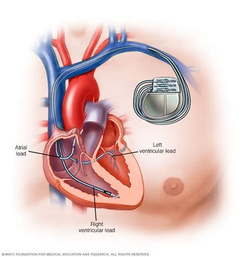 Pacemaker - Mayo Clinic