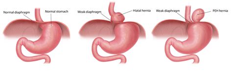 Paraesophageal Hernia – GBMC Jordan