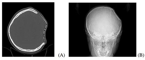 Deformation of cranioplasty titanium mesh in a paediatric patient ...