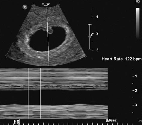 Ultrasound Series: Part 3 Heartbeat - Crossroads Pregnancy Center