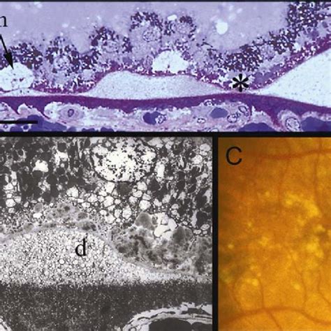 1-5 Membranous debris: basal mounds and soft drusen | Download ...