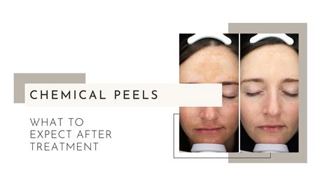 What To Expect After A Chemical Peel | Atalo Aesthetics Cincinnati MedSpa