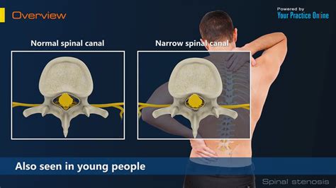 Spinal Cord Stenosis