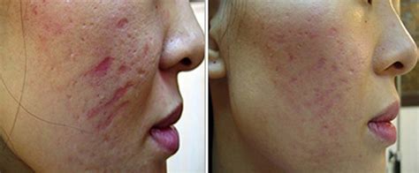 Derma Roller Before And After Picture Acne Scars