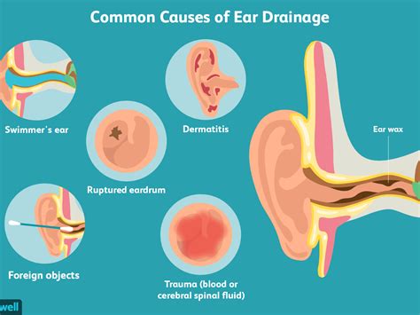 How To Reduce Fluid In The Ear - Tomrelation7