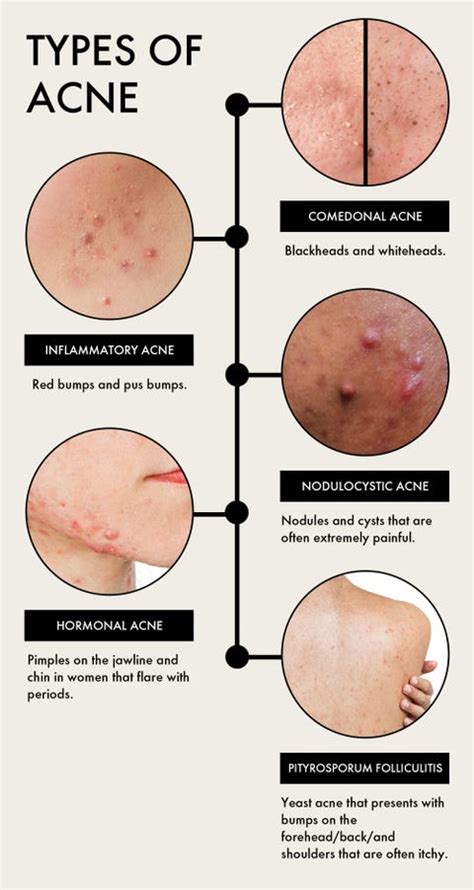 The Complex Relationship Between Makeup And Acne: A Comprehensive Guide ...