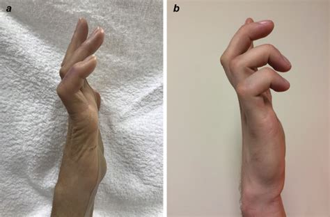 Ulnar claw: A kinder, gentler solution - Journal of Hand Therapy