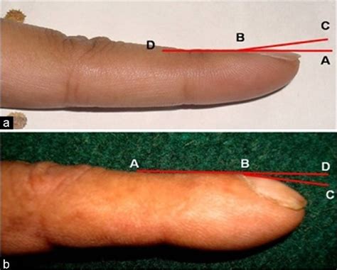 Digital Clubbing or Nail Clubbing - Causes and Grading | medcaretips.com