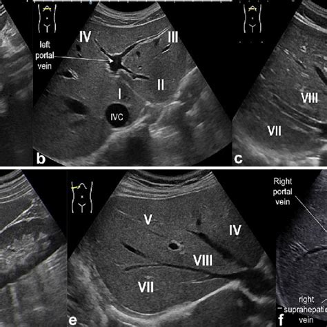 US study of the liver: longitudinal and transverse scan along the ...