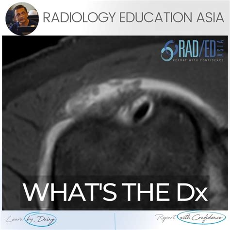 SUBACROMIAL SUBDELTOID BURSITIS MRI RADIOLOGY (VIDEO) - Radedasia