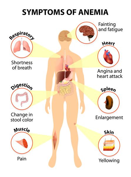 Diamond-Blackfan anemia: MedlinePlus Genetics