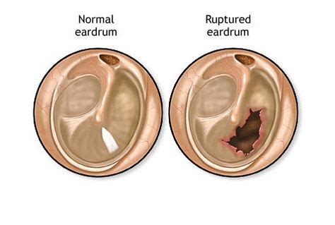 A perforated eardrum is a tear or hole in the ear's tympanic membrane ...