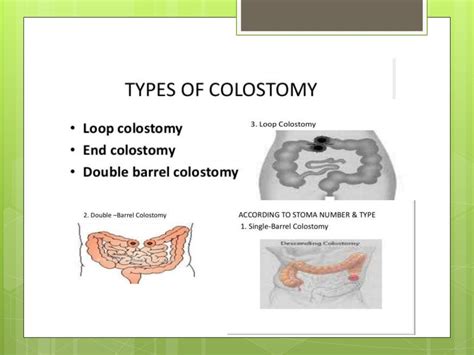 Colostomy